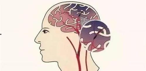 脑梗偏瘫吃酥瓜好吗视频,营养美味两不误